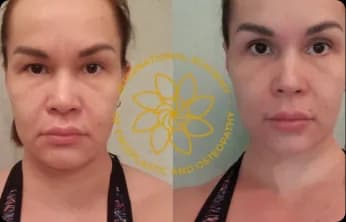 Swelling disappeared, face is more even and firm, double chin diminished, nasolabial folds reduced, dark circles under the eyes lessened, and the face looks younger and more open.